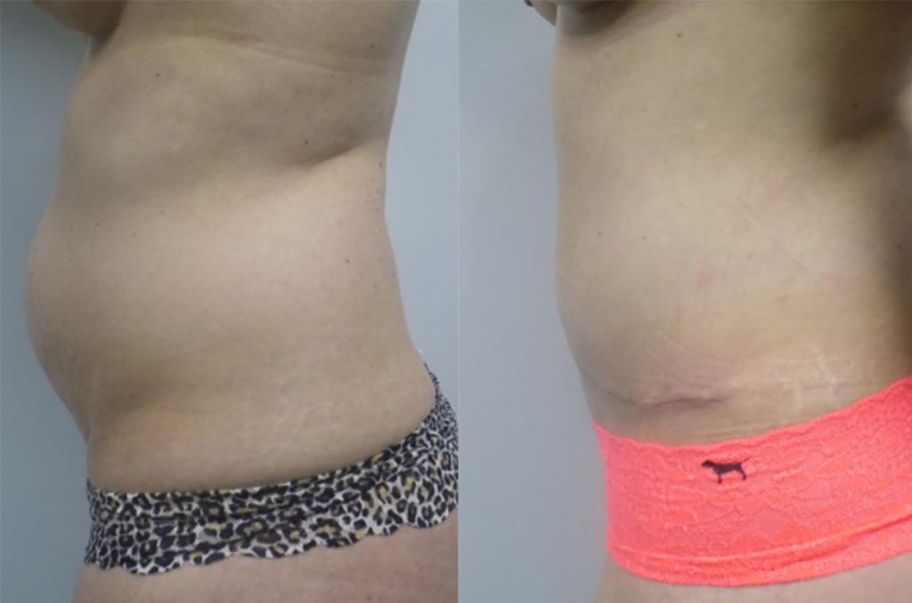 Adding a Pubic Lift to Your Tummy Tuck