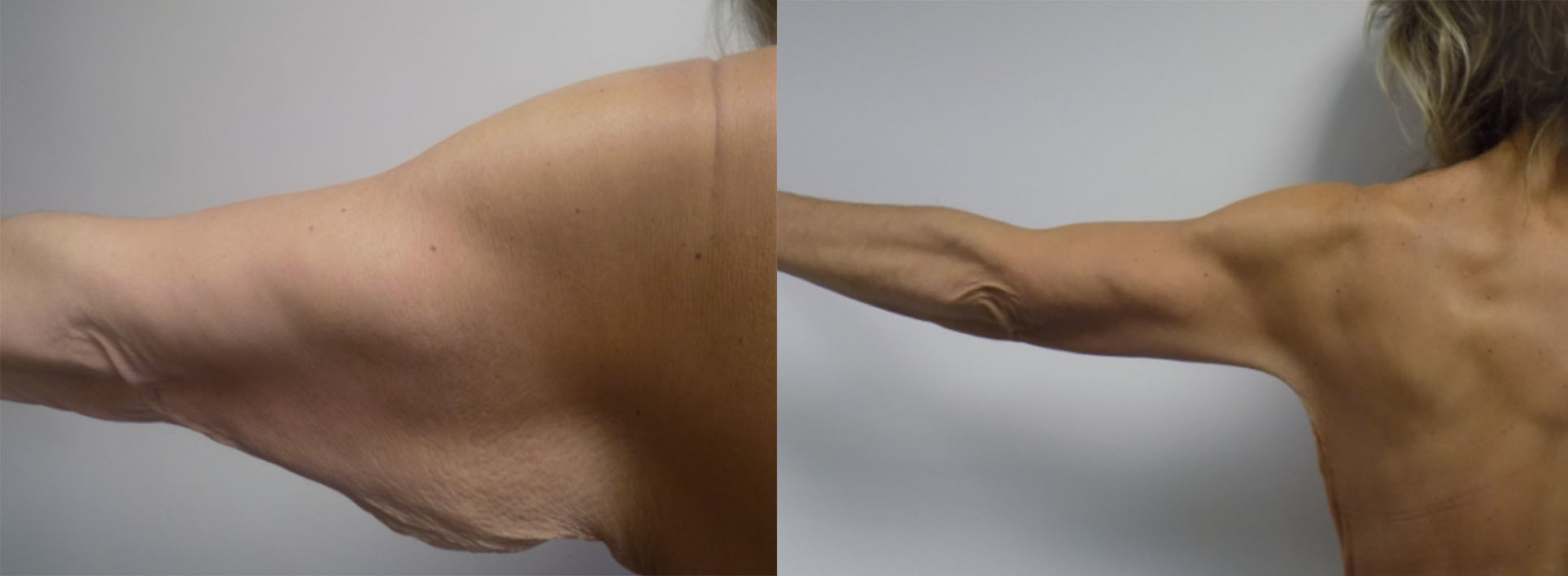 Arm Lift Procedure - Brachioplasty